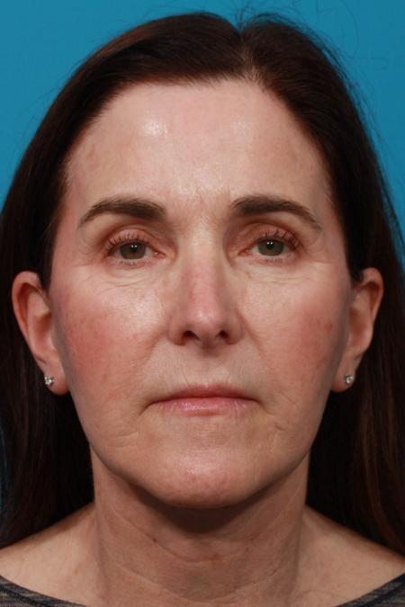 After image 1 Case #103806 - Face Lift and Brow Lift