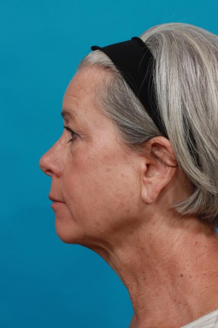 Before image 3 Case #103976 - Face Lift / Quad Bleph