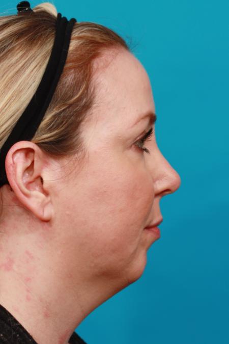 Before image 3 Case #104251 - Chin Augmentation