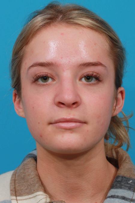 After image 1 Case #103736 - Rhinoplasty