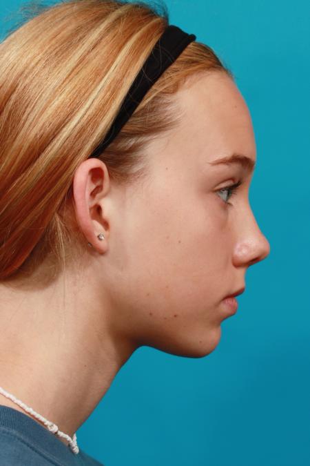 Before image 3 Case #104121 - Otoplasty