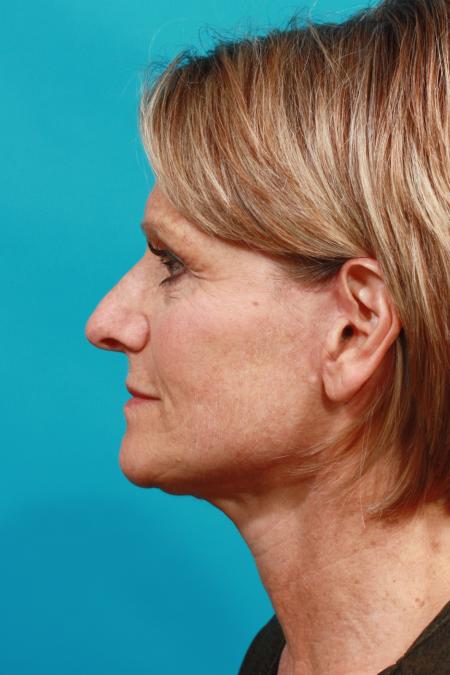 After image 3 Case #104046 - Neck Lift