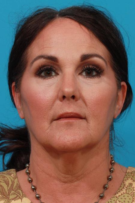 Before image 1 Case #103801 - Face Lift