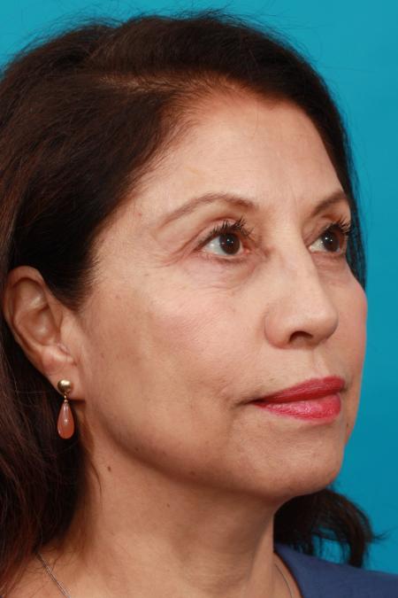 After image 2 Case #104381 - Blepharoplasty