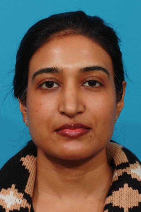 After image 1 Case #103781 - Rhinoplasty