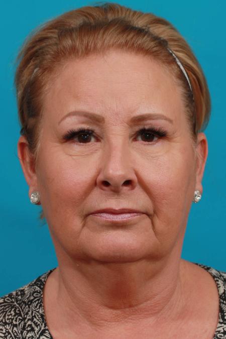 Before image 1 Case #103916 - Face Lift