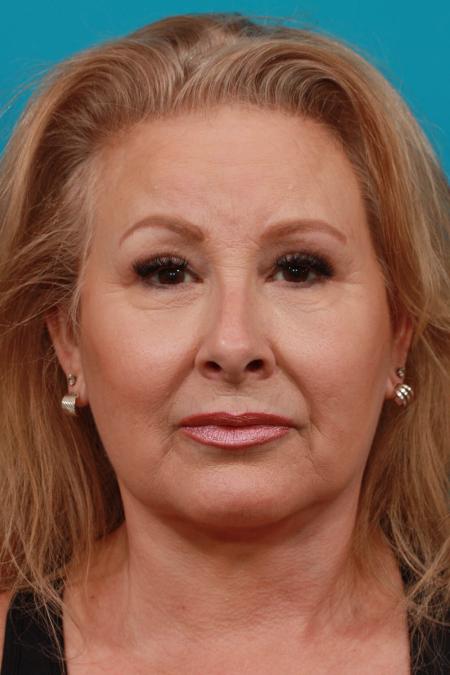 After image 1 Case #103916 - Face Lift