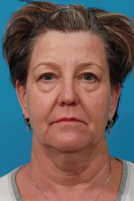 Before image 1 Case #103836 - Face Lift