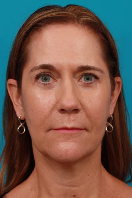 After image 1 Case #104241 - Blepharoplasty