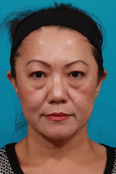 Before image 1 Case #104011 - Blepharoplasty
