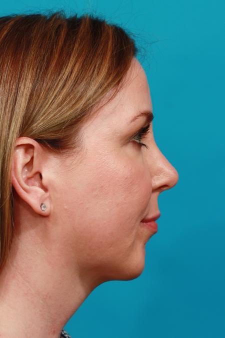 After image 3 Case #104251 - Chin Augmentation