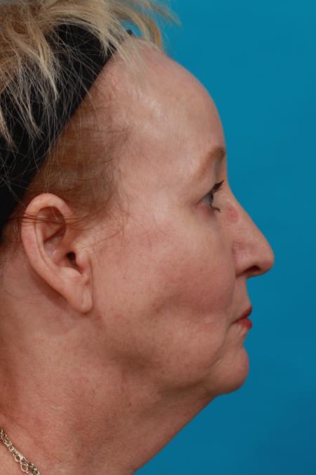 Before image 3 Case #104171 - Blepharoplasty