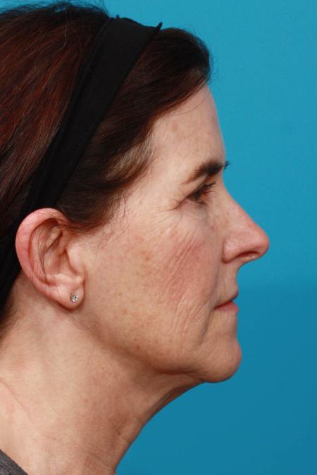 Before image 3 Case #103806 - Face Lift and Brow Lift