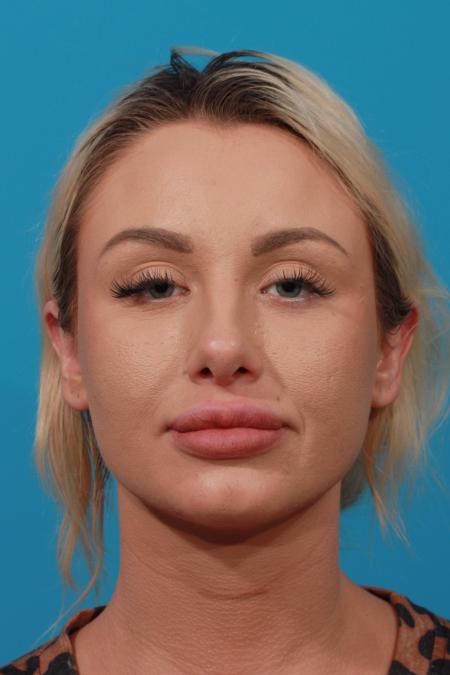 After image 1 Case #104136 - Rhinoplasty