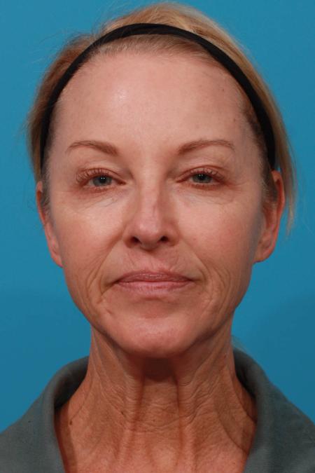 Before image 1 Case #103726 - Facelift