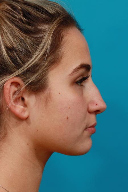 Before image 3 Case #104326 - Rhinoplasty