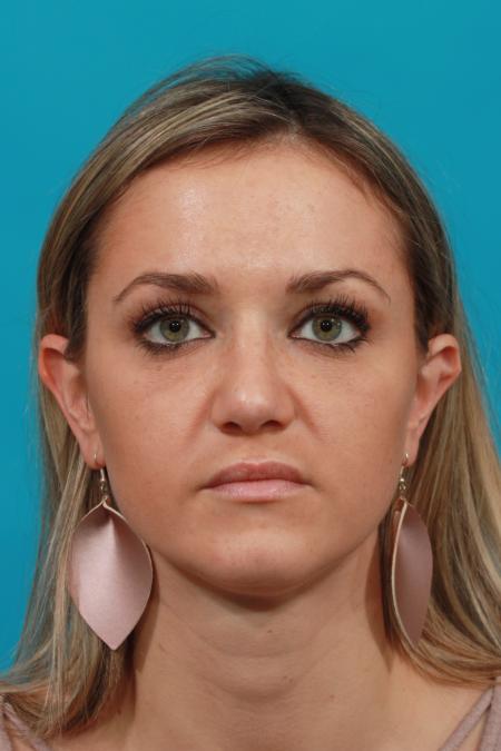 After image 1 Case #104096 - Rhinoplasty