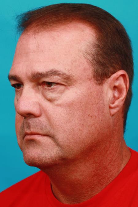 Before image 2 Case #104181 - Blepharoplasty