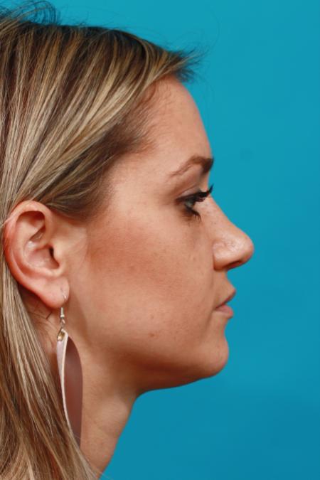 After image 3 Case #104096 - Rhinoplasty