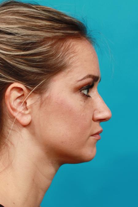 Before image 3 Case #104096 - Rhinoplasty