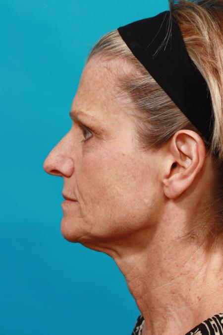Before image 3 Case #104046 - Neck Lift