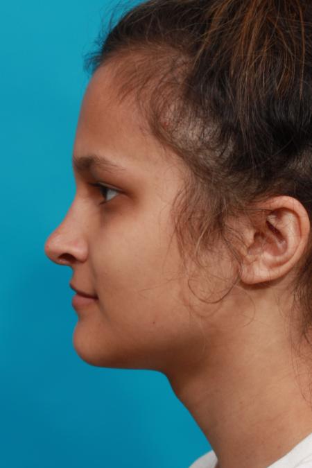 After image 3 Case #104141 - Rhinoplasty