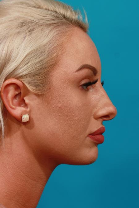 Before image 3 Case #104136 - Rhinoplasty