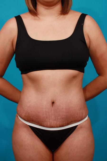 After image 1 Case #104076 - Tummy Tuck