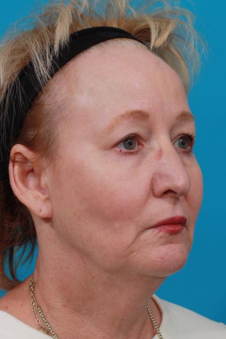 Before image 2 Case #104171 - Blepharoplasty