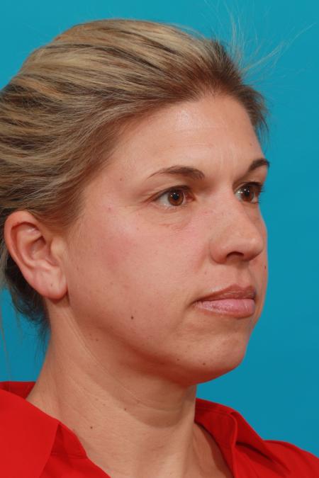 Before image 2 Case #104216 - Blepharoplasty