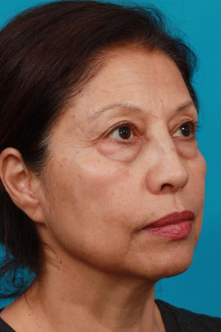 Before image 2 Case #104381 - Blepharoplasty