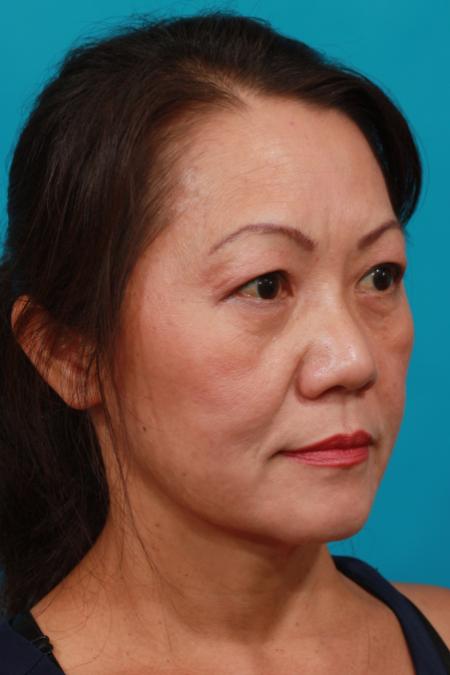 After image 2 Case #104011 - Blepharoplasty