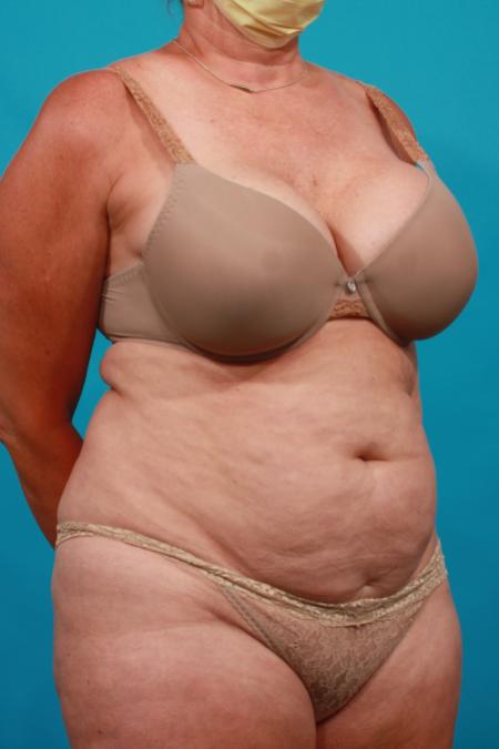 Before image 2 Case #104066 - Tummy Tuck: SAL