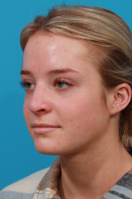 After image 2 Case #103736 - Rhinoplasty
