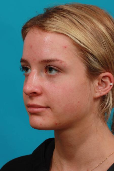 Before image 2 Case #103736 - Rhinoplasty