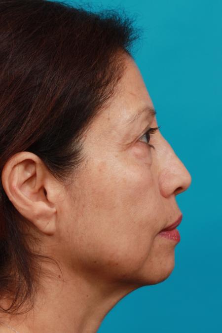 Before image 3 Case #104381 - Blepharoplasty