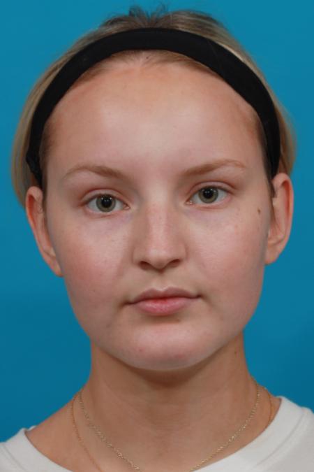 Before image 1 Case #104371 - Rhinoplasty