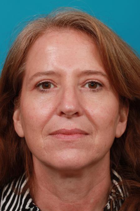 After image 1 Case #104091 - Blepharoplasty