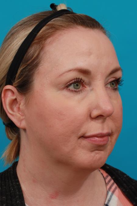 Before image 2 Case #104251 - Chin Augmentation