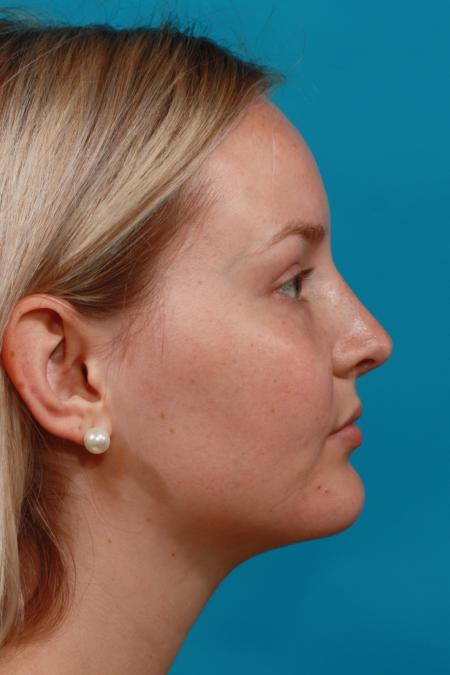 After image 3 Case #104371 - Rhinoplasty