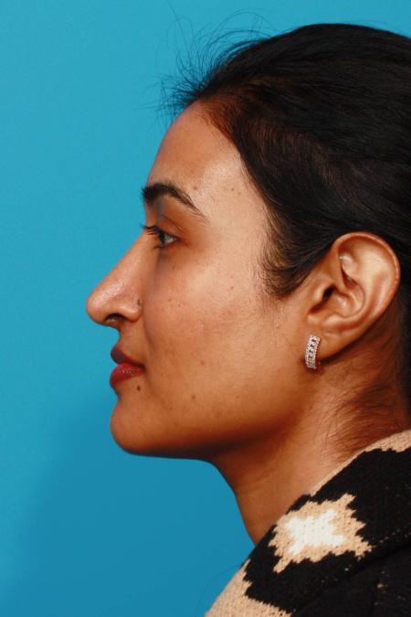 After image 3 Case #103781 - Rhinoplasty