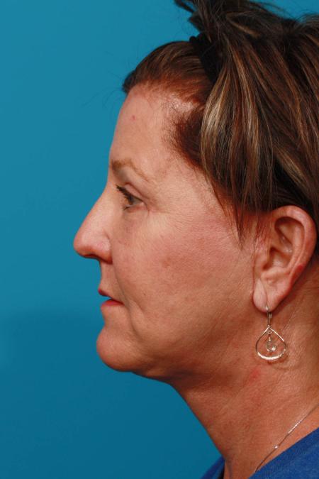 After image 3 Case #103836 - Face Lift