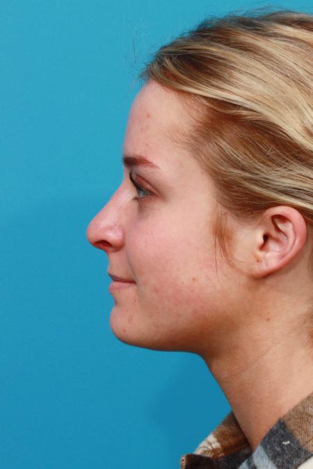 After image 3 Case #103736 - Rhinoplasty