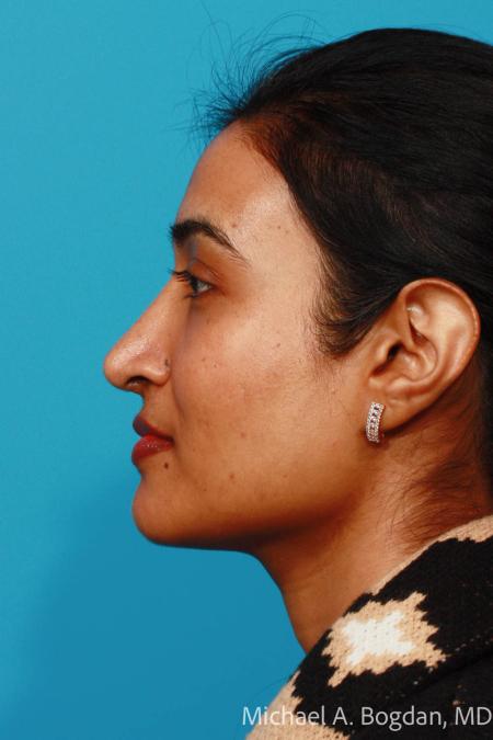 After image 3 Case #103876 - Rhinoplasty