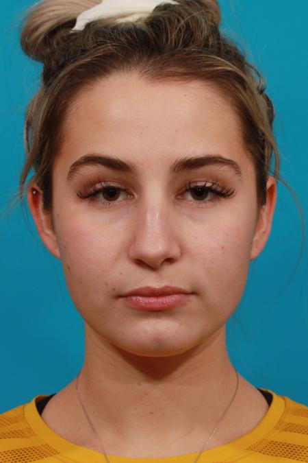 Before image 1 Case #104326 - Rhinoplasty