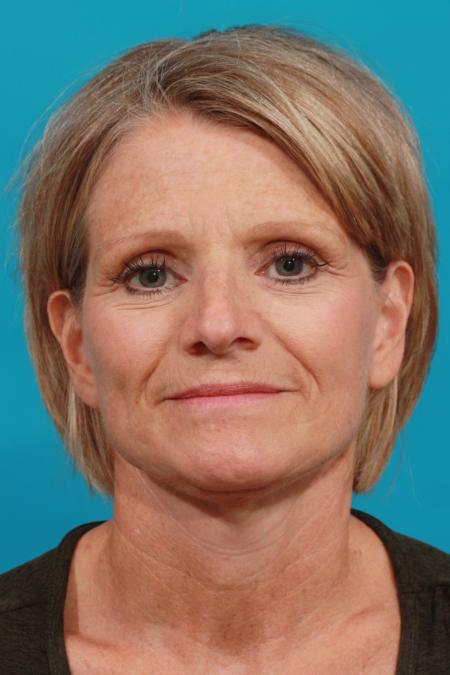 After image 1 Case #104046 - Neck Lift