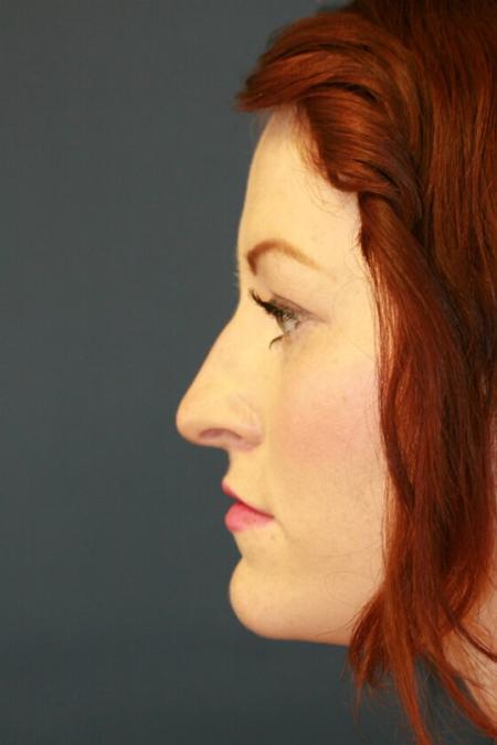 Before image 3 Case #105356 - Rhinoplasty