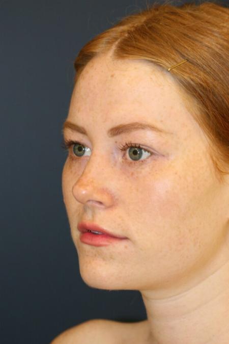 After image 2 Case #105356 - Rhinoplasty