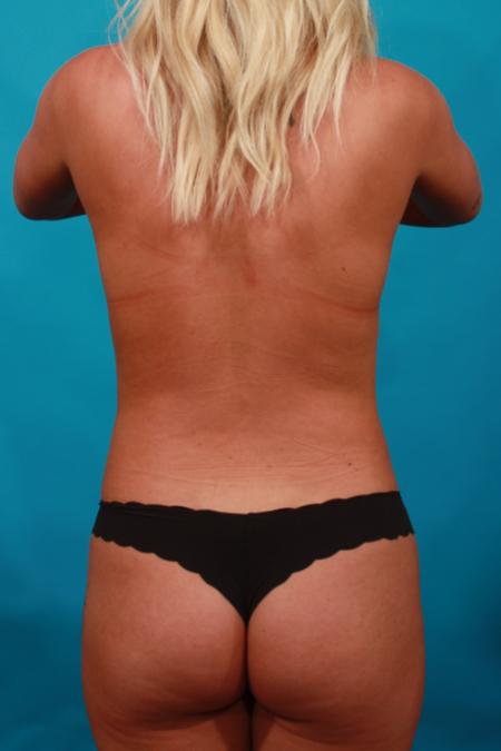 Before image 5 Case #104016 - Liposuction