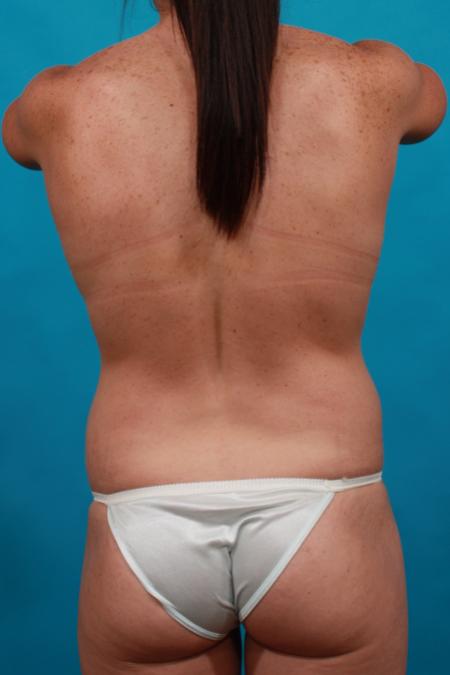 Before image 5 Case #103971 - Mommy Makeover:  TT, BL, BA, SAL